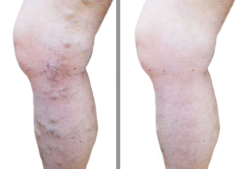 脚上的血管像蚯蚓一样是怎么回事,小腿上的血管像小蚯蚓一样