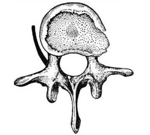膨出型突出型脱出型游离型分类,腰椎间盘膨出和腰间盘突出的区别