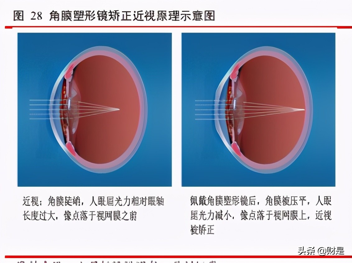 爱博医疗眼科器械上市,眼科行业研究报告
