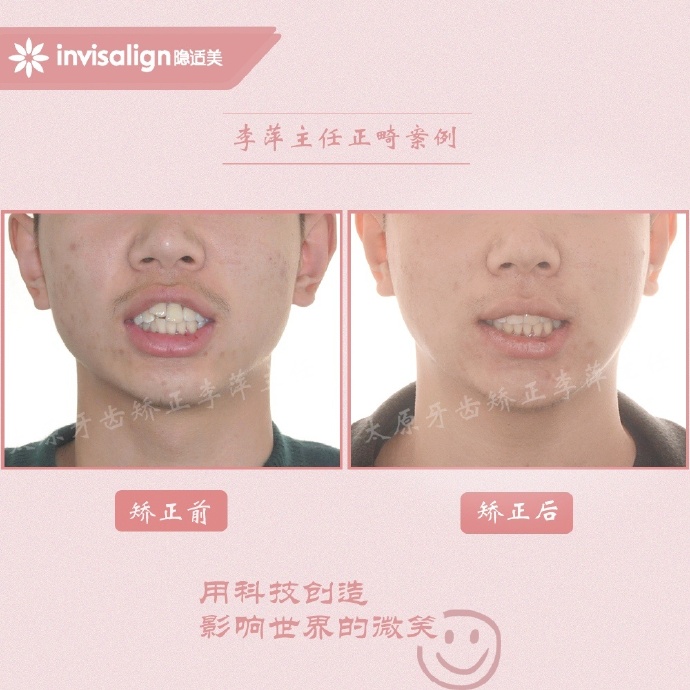 重度牙齿拥挤矫正经历,太原矫正牙齿需要多久