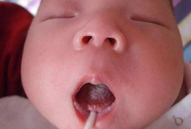 鹅口疮奶渍区分图片,如何轻松搞定鹅口疮月嫂速看