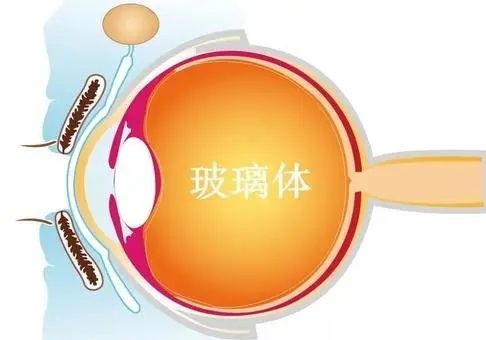 眼前有黑点飞蚊症,眼前有飞蚊症是怎么回事