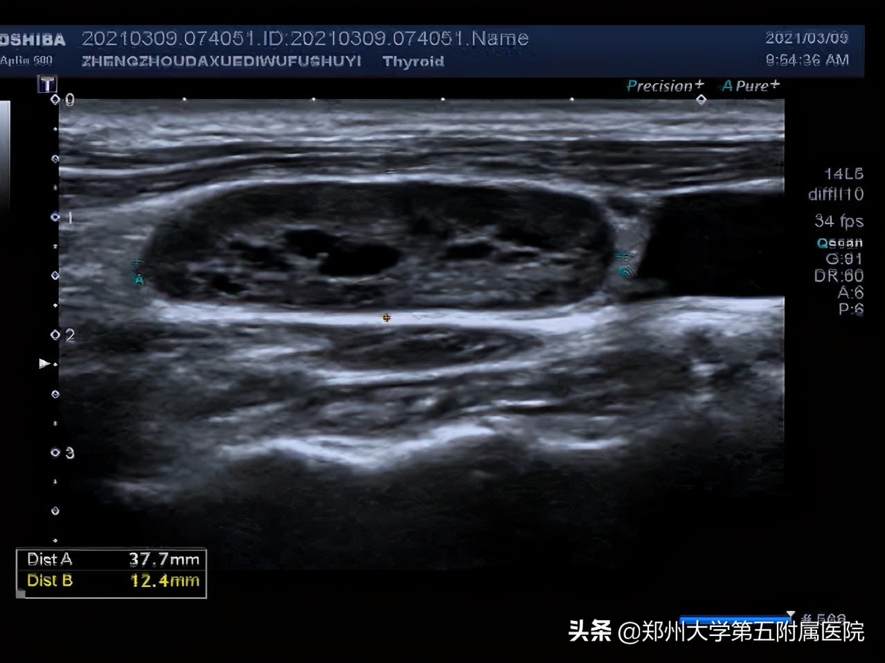 有一个小小的淋巴结,淋巴结有小尾巴