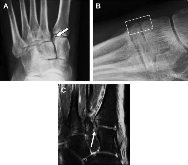 值夜班急救措施,放射科容易漏诊的骨折