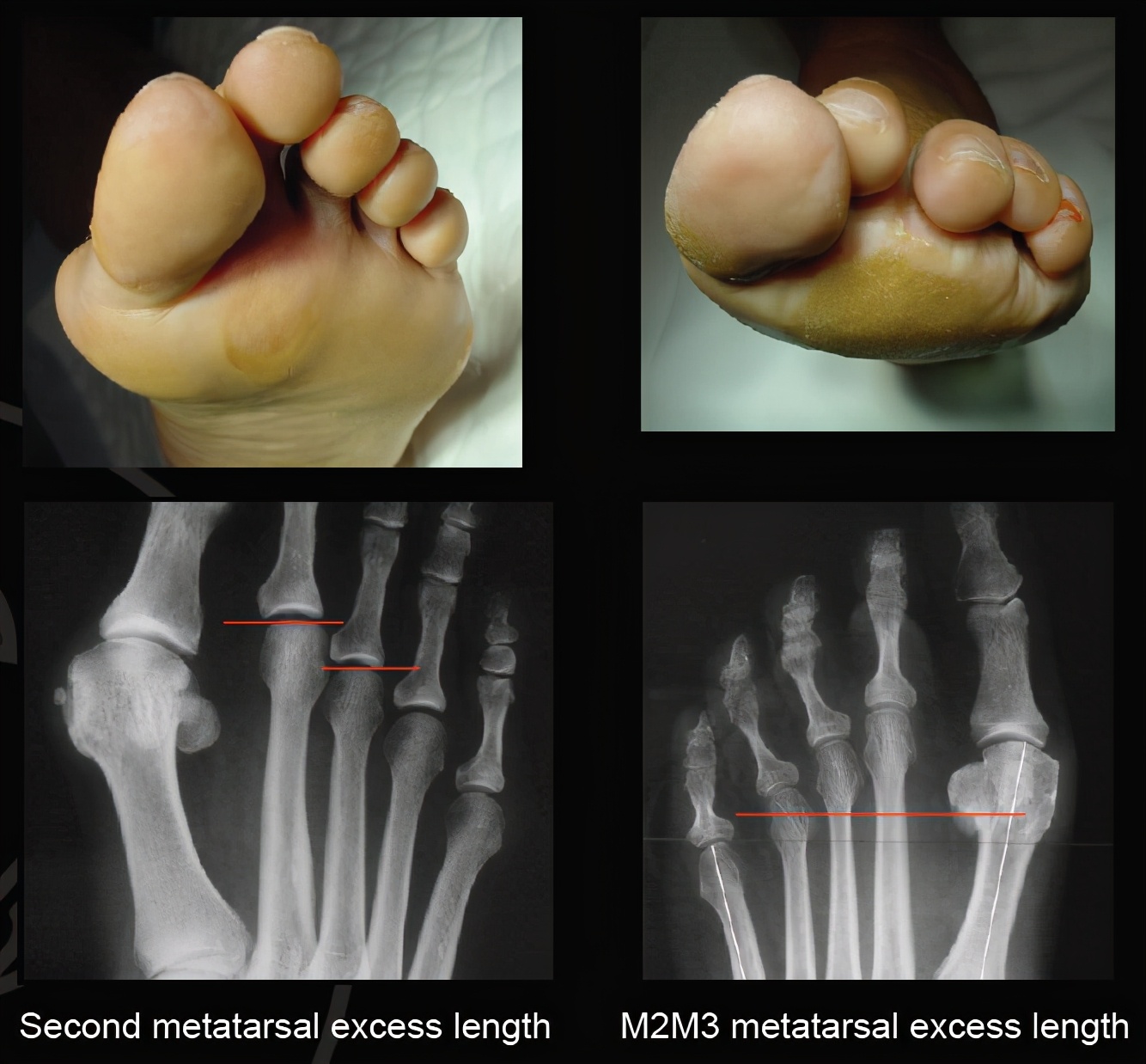 脚底长茧子什么原因,脚底长茧子是什么原因