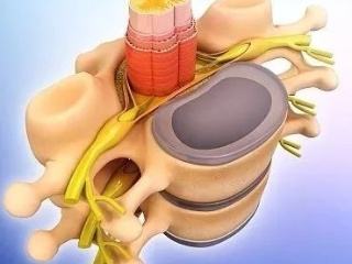 腰椎间盘4-5节突出牵引治疗的图片,十四岁腰椎间盘突出怎么治疗