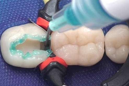 补牙一段时间后疼痛是什么情况,补牙几年以后又疼了是为什么