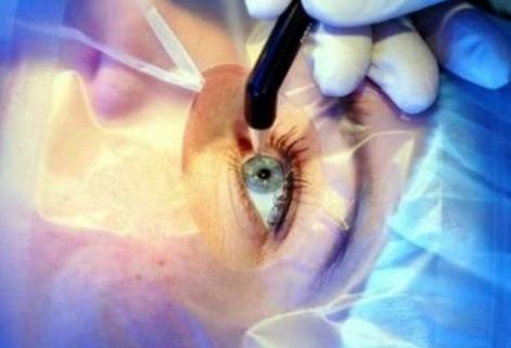 激光矫正近视人人都能做？NO，符合这三大条件即可