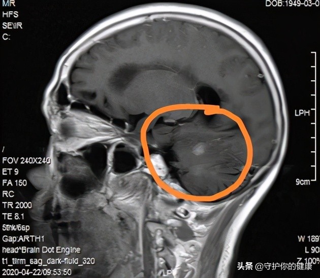 脑转移不能放疗了怎么办,脑转移不治疗的生存期
