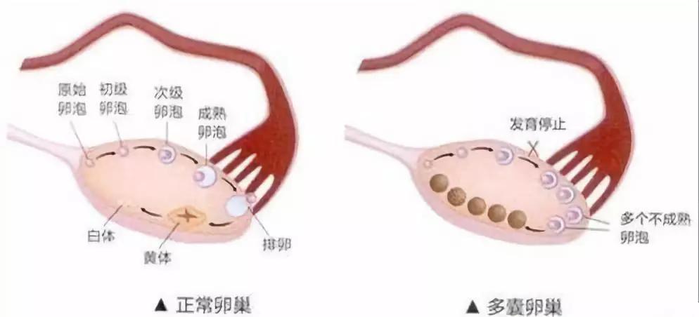 月经后错、多毛、长痘、肥胖，警惕多囊卵巢综合征