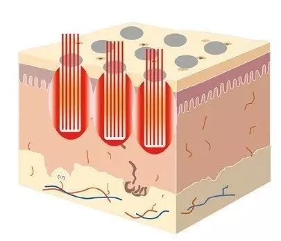 易科美点阵激光仪对痘坑有用吗,点阵激光真的有效果吗