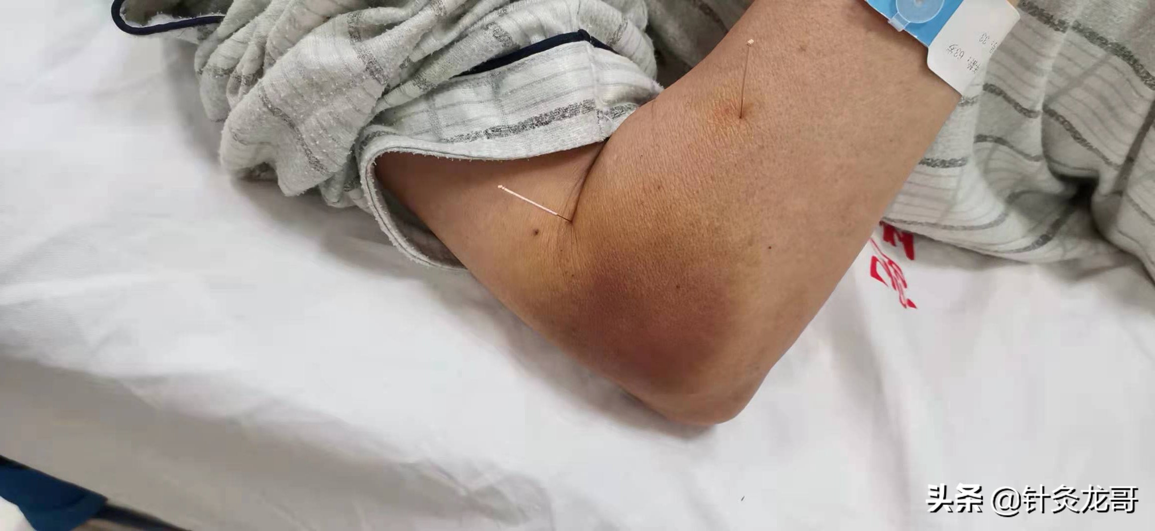 针灸出现淤青怎么办?会影响疗效吗?