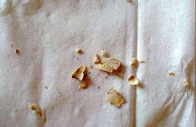 牙齿掉了有个软软的东西,牙齿上抠出黑色硬硬的东西是什么