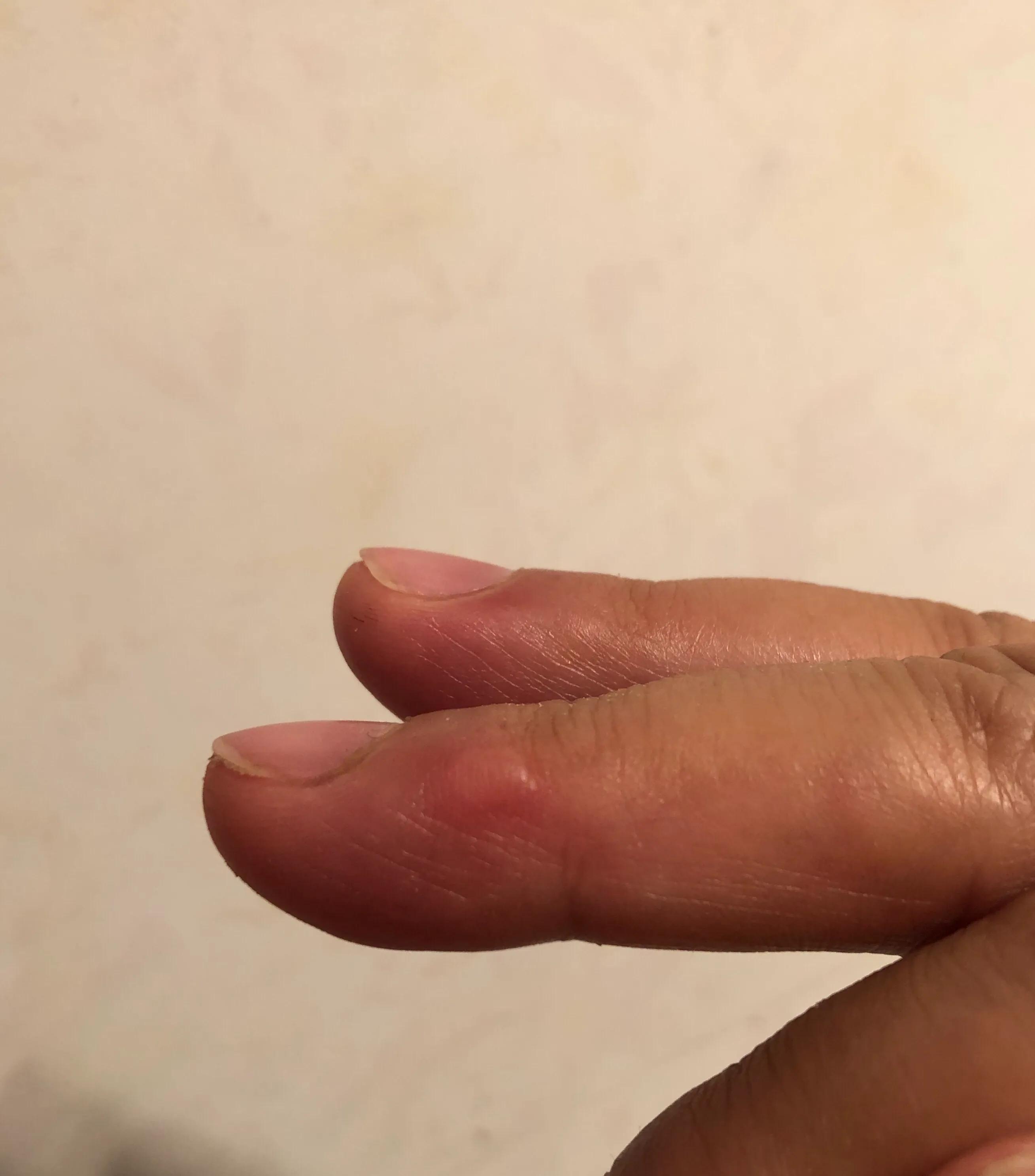 油煎了手起泡怎么办,油煎柿子糕