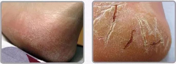 冬天脚后跟干裂用什么润脚霜,润足脚后跟干裂修复霜