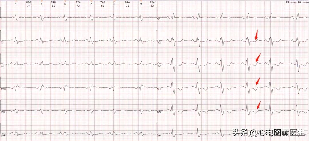 完全性右束支传导阻滞注意什么,完全性右束支传导阻滞如何解决