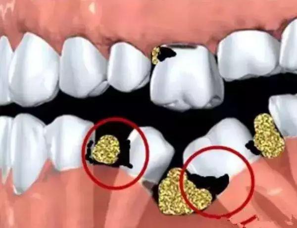 连缺三颗下门牙怎么镶好,明明缺一颗牙为什么要套三颗