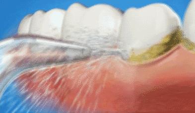 牙齿发黄变白小窍门,小孩牙齿发黄是什么原因如何去除