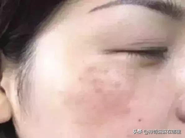 为什么用美白精华皮肤变白,为什么用了美白护肤品反而变黑了