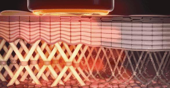 热拉提热玛吉fotona4d怎么选,热拉提抗衰