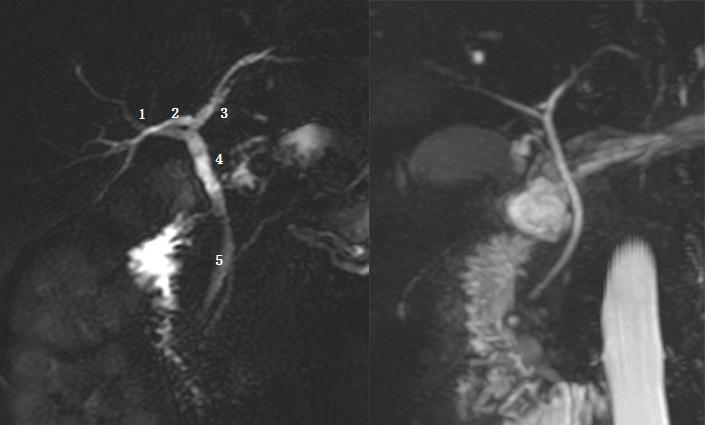 胆道系统解剖生理讲课视频,超声胆道系统的解剖生理