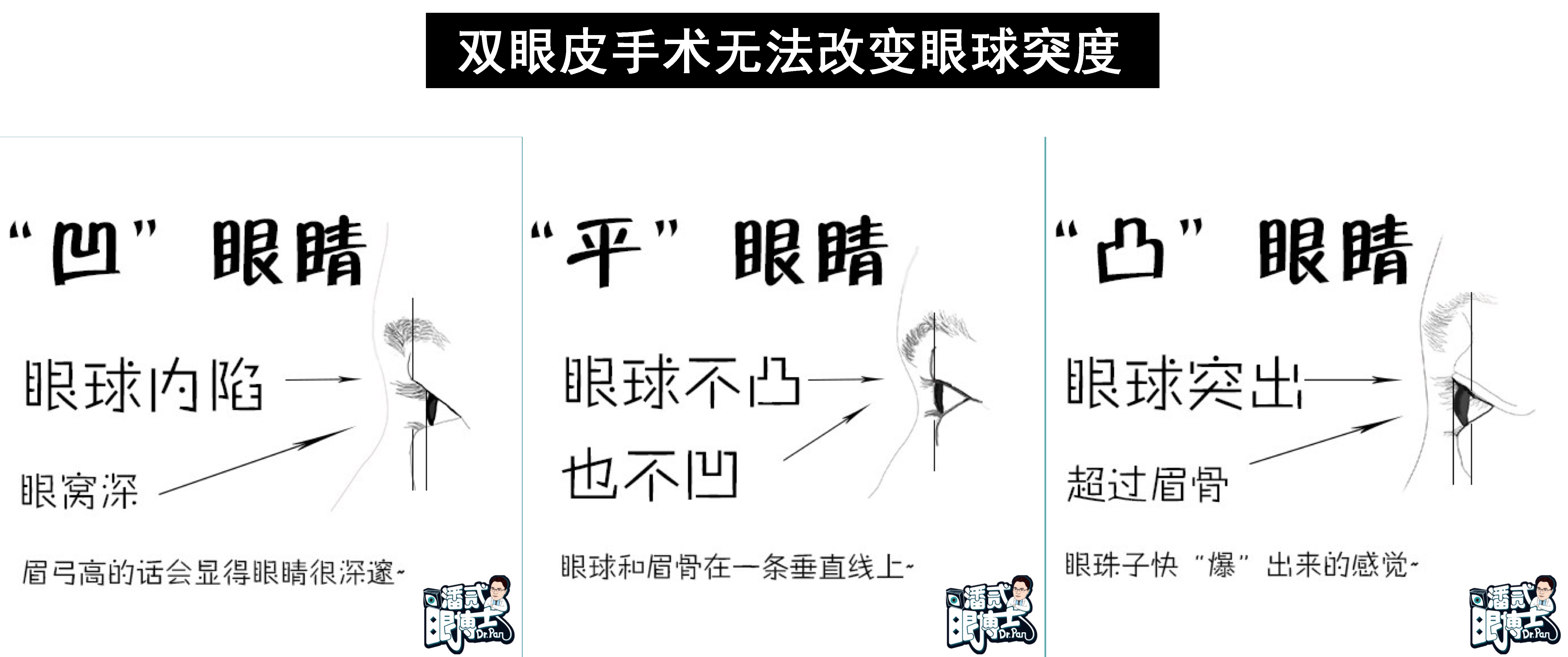 在原有双眼皮的基础上割双眼皮,割双眼皮不知道开扇形还是平行形
