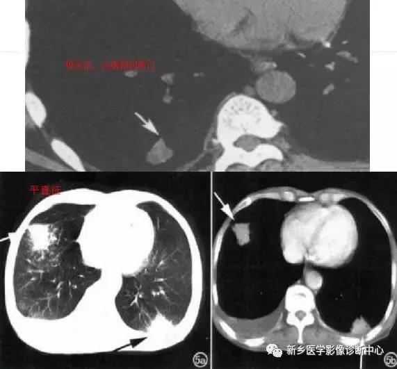 肺部有球形病灶怎么治疗,肺内多发结节诊断早期肺癌怎么办