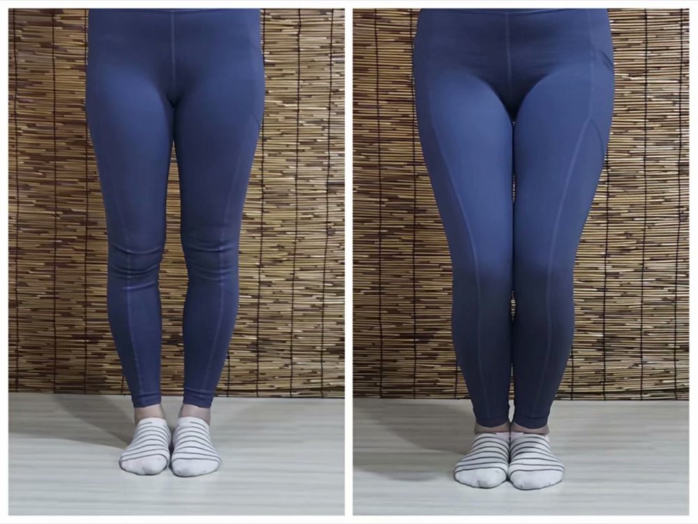 穿纸尿裤对孩子腿型有影响吗,小时候腿不正长大后会矫正吗