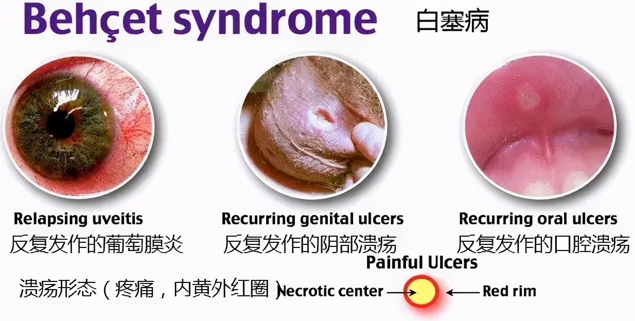深圳男子口腔溃疡8年，还蔓延全身！竟是这种怪病！
