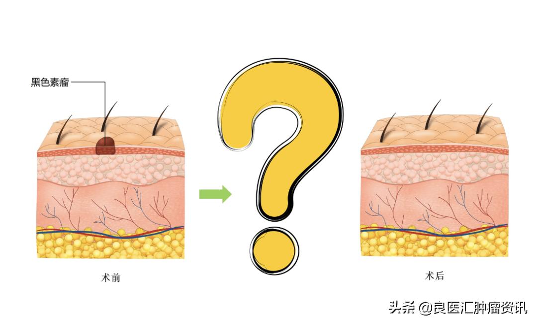 黑色素瘤中晚期能治愈吗,二期黑色素瘤复发率很高是吗