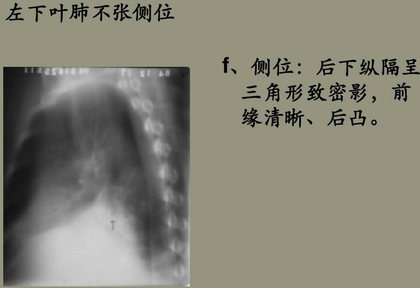 x线诊断边界模糊,x线诊断有误区吗