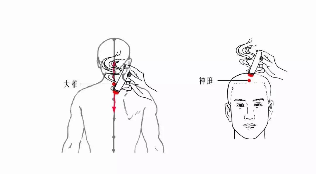 颈椎腰腿痛针刀,针刀颈椎病