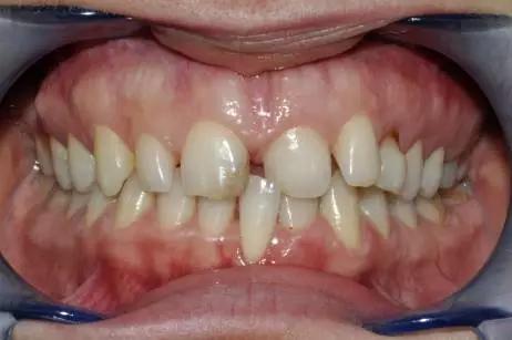 两门牙中间的缝隙越来越大,为什么门牙缝隙大这么难看