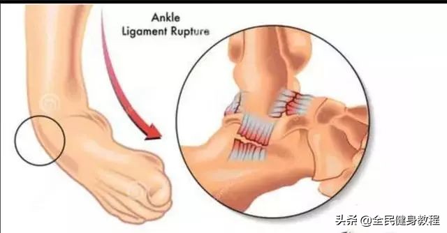 踝关节扭伤需要引起足够的重视,足踝扭伤的注意事项