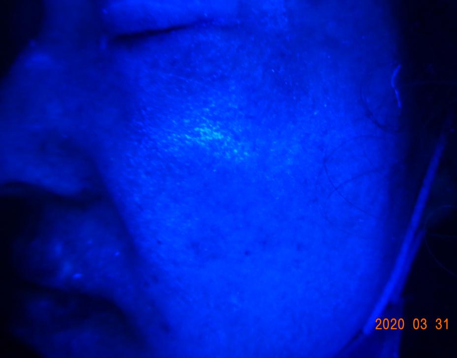 白癜风治愈一百例,白癜风治愈患者分享痊愈经验