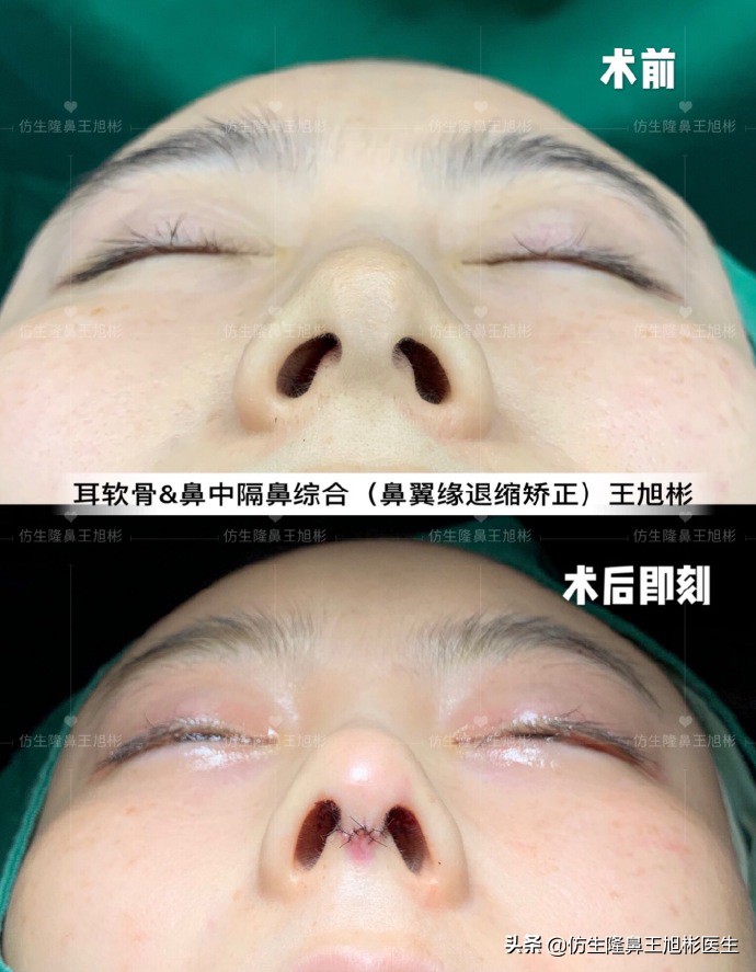 王旭彬：朝天鼻、露鼻孔，模特菲菲短鼻矫正手术后1.5个月