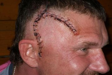 世界上完全可以预防的癌症疫苗,未来10年癌症有可能被攻克吗