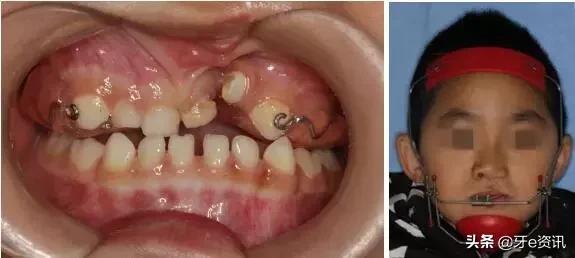 狗狗乳牙地包天怎么办,儿童乳牙地包天怎么办