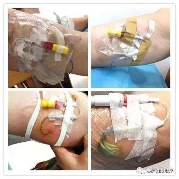 不可不知道的PICC置管后的居家护理