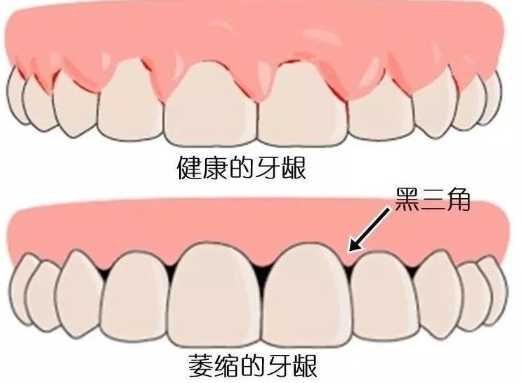 为什么牙齿黑三角不可逆,黑三角是不可逆的吗