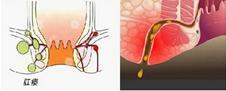 你出现过肛瘘吗,关于肛瘘的病例