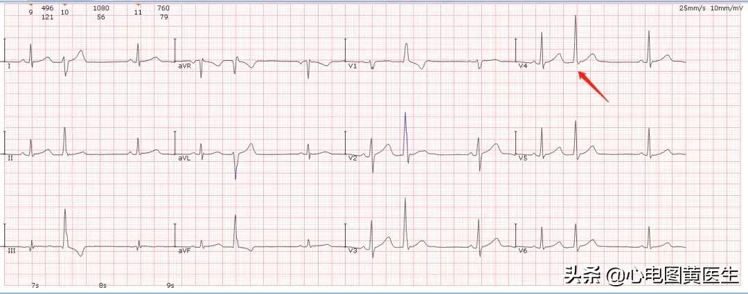 频发室性早搏部分为室性融合波,室性早搏与差异性传导鉴别