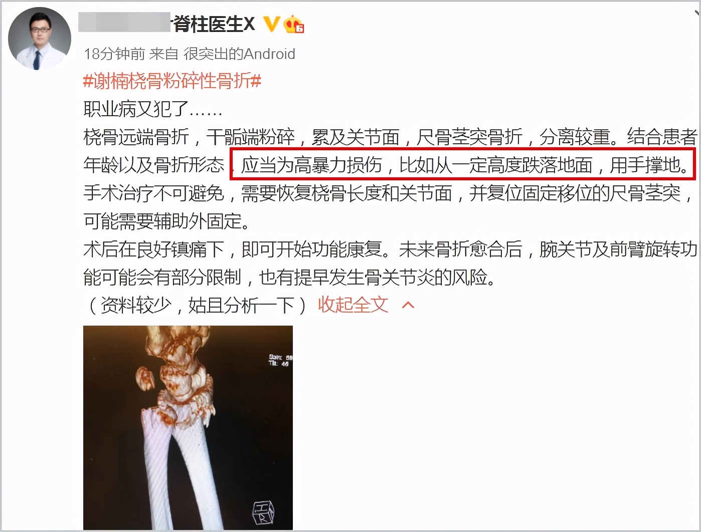 谢楠骨折要动手术，X光照可见明显碎骨，医生：高*力暴**损伤所致