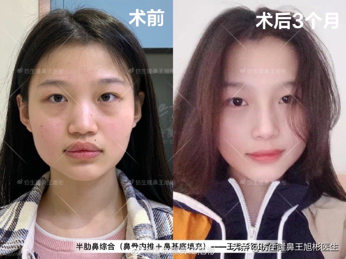 那些被鼻子“封印”颜值的鼻综合/修复案例|广州鼻整形