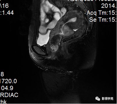宫颈癌mri诊断,宫颈癌的mr扫描技术