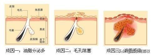 脸上痘痘爆脓怎么处理,小孩脸上痘痘怎么处理