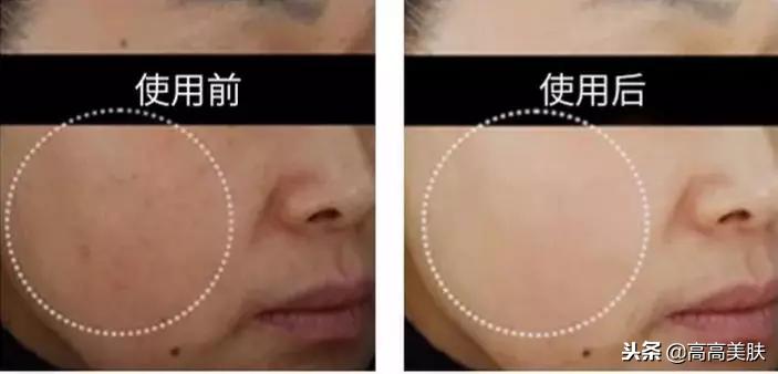 韩国东星制药美白祛斑霜,东星琅丝曲酸小黑瓶祛斑霜