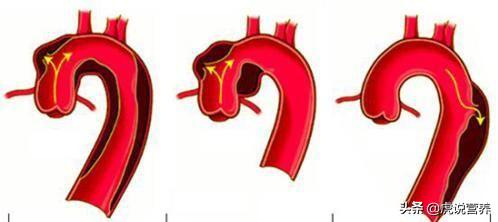 知名歌手得了可怕的心脏主动脉夹层,你了解吗
