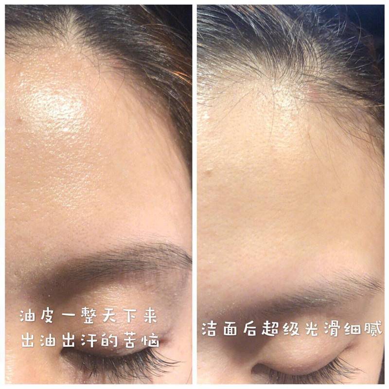 去黑头粉刺的最有效最简单的方法,你不能不知道的去粉刺秘籍