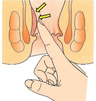 什么属于内痔一期,什么是外痔什么是内痔